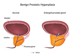 prostata2 0 - Операция на опухоль простаты методом HoLEP