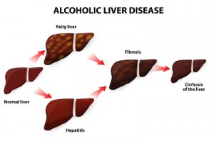 alcoholic liver 300x199 - Лечение печени в Израиле